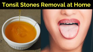 How to Cure Tonsillitis Permanently  Tonsil Stones Removal at Home  Tonsils Home Remedy [upl. by Cadmarr]