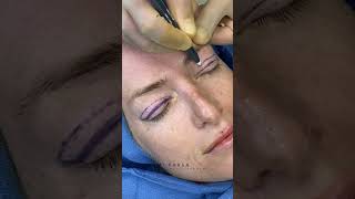 Upper Blepharoplasty for Hooded Upper Eyelids  Dr Kami Parsa  Droopy Eyelids [upl. by Aubin]