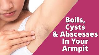 How To Treat Boils Cysts and Abscesses in Your Armpit  Lumps in The Armpit [upl. by Ebony835]