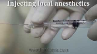 Spinal anesthesia [upl. by Erasaec]