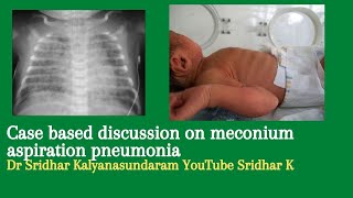 Meconium aspiration pneumonia Neonatal MAS Dr Sridhar K [upl. by Rosemonde]