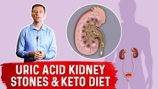 Uric Acid Kidney Stones amp Keto Diet – Dr Berg [upl. by Nemad]