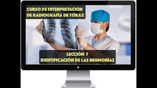 CURSO DE INTERPRETACIÓN RADIOGRAFÍA DE TÓRAX IDENTIFICACIÓN RADIOLÓGICA DE LAS NEUMONÍAS [upl. by Diandra]