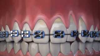 Gum Recession After Wearing Braces Can Now Be Treated Without Gum Grafting Surgery [upl. by Asilehc]