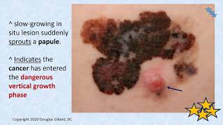 Malignant Melanoma The Most Deadly Form of Skin Cancer Primary Health Care Providers Cant Miss It [upl. by Nnomae810]