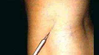 Tratamiento esclerosante de varices  Sclerosing Treatment of Varicose Veins  Sclerotherapy [upl. by Pirozzo596]