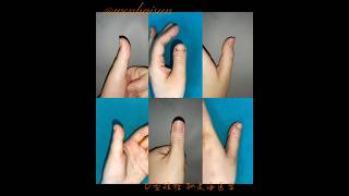 Brachydactyly Type D distraction lengthening brachydactyly doctor thumb meganfox [upl. by Ardrey653]