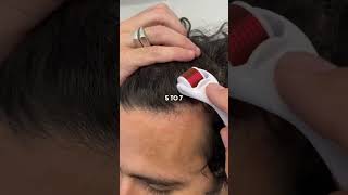 Derma roller hair regrowth treatment 😍💆‍♀️ hairgoals selfcare beautyroutine [upl. by Anyaled]