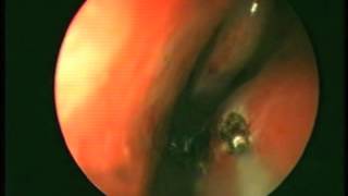 Reducción de cornetes inferiores con láser diodo de 980nm  Inferior turbinates with 980nm diode l [upl. by Cristine39]