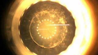 Capsulotomy treatment laser femto Victus wmv [upl. by Akcire]