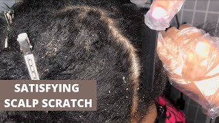 Itchy Flaky Scalp Treatment  Seborrheic Dermatitis [upl. by Mcnutt933]