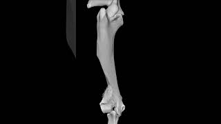 What is a humeral condylar fracture [upl. by Ardnajela]