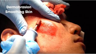 Dermabrasion Smoothing Acne Scar Skin [upl. by Kiele]