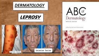 DERMATOLOGY  LEPROSY tuberculoid amp lepromatous derma lesion leprosy [upl. by Codd]