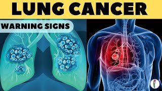 Lung Cancer Warning Signs II Lung Cancer Symptoms [upl. by Aeslehc90]