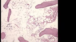 Dr Naglaa Salem MD FCAP Interpretation of BM Biopsies [upl. by Glennie]