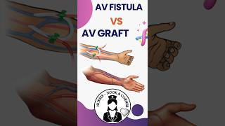 AV Fistula vs Graft shorts dialysis london nursing medico [upl. by Assetnoc538]