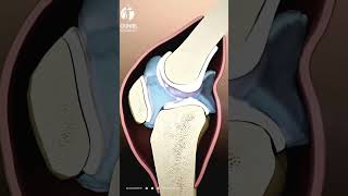 Arthrite du genou expliquée  Les bases à connaître pour prendre le contrôle [upl. by Nueoht]