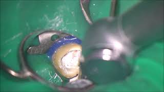 Sealer based obturation of Cshaped root canals in a retreatment case [upl. by Nayt]