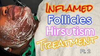 Inflamed Follicles Hirsutism Treatment Skincare wextractions pt 2 FOLLOWUP [upl. by Finegan]