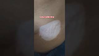 Leucoderma Desi treatment Visit Anm Herbal Health and skincare clinic Lucknow skincare [upl. by Eelyme]