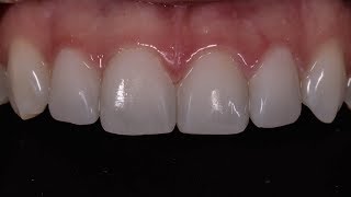 Composite Veneers [upl. by Tiffanle]