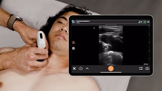 Ultrasound for Subclavian Central Line Placement [upl. by Vivianna894]