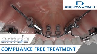 amda®  compliancefree treatment advanced molar distalization appliance [upl. by Jala]