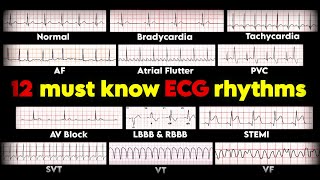 12 must know ECG rhythms  ECGEKG interpretation • Daily Cardiology [upl. by Cynde]