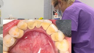 Professional teeth cleaning  removal tartar  scaling teeth [upl. by Edmee]