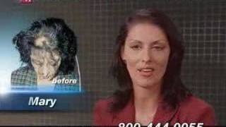 Female Hair Loss Patient Video for Medical Hair Restoration [upl. by Kirwin]