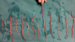 Doctors Remove 14 Roundworms From Woman [upl. by Slosberg354]