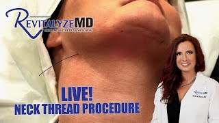 INSTANT Neck lift Watch LIVE a NonSurgical PDO Thread Lift Procedure [upl. by Merlina]