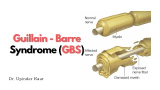 Guillian  Barre Syndrome GBS  HINDI [upl. by Adams]