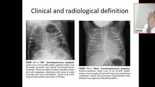 Bronchopulmonary dysplasia definition chronic lung disease [upl. by Adyl]