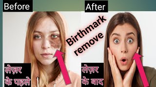 Birthmark Remove Birthmark theek kare [upl. by Anilatsyrc]