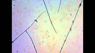 Morgellons fluid wire growth [upl. by Kamerman584]