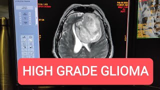 Imaging Tumors  High Grade Glioma MRI Brain with Contrast [upl. by Ive989]