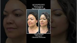 Nonsurgical Neck amp Facelift  SculptLyft [upl. by Letty]