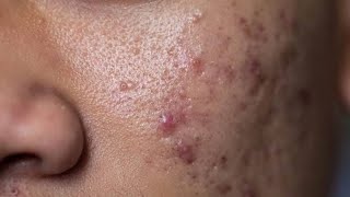 Best Pharmacy cream for acne pimples blackheads whitheads forehead small bumbs [upl. by Khalid624]