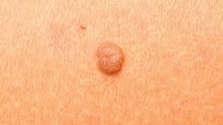 How to Remove Skin Tags at Home DermTVcom Epi 511 [upl. by Tod]