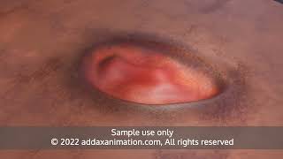 wound repair product medical animation [upl. by Stryker337]