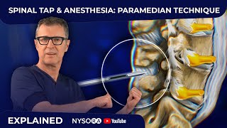 Spinal Tap  Anesthesia Paramedian Technique  Crash course with Dr Hadzic [upl. by Einatirb]