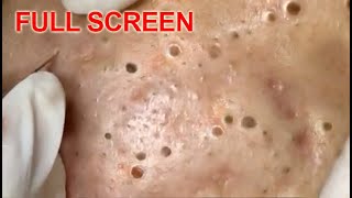 LARGE Blackheads Removal  Best Pimple Popping Videos [upl. by Alverta]