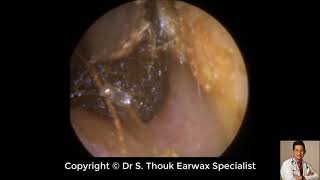 Top Biggest Ear Wax Removal 96  Ear wax Extraction  Dr S Thouk Earwax Specialist [upl. by Sucerdor]