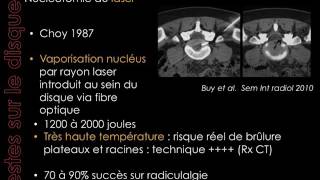 Traitement percutané des lésions du disque intervertébral  MORVAN G HAUGER O [upl. by Sikleb188]