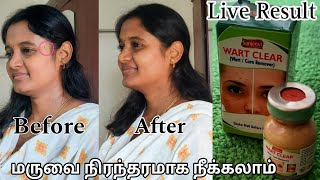 Wart Remover Honest Review in Tamil  வலியே இல்லாமல் மருவை நிரந்தரமாக நீக்கலாம்  Wart Remover Tamil [upl. by Ientruoc]