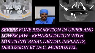 Severe bone Resorption in upper and lower jaw  rehabilitation with multiunit basal dental implants [upl. by Iznyl]