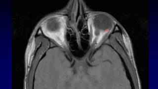 Imaging of the Eye and Orbit Part 2 [upl. by Silrak]