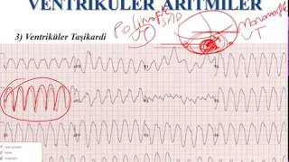 EKG  Ventriküler Aritmiler ECG  Ventricular Arrhythmias [upl. by Navis]